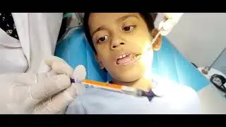 Root Canal Treatment in kids tooth देखिए live video || @rootcanaltre @Smileopenlywithdrpoonam