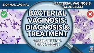 Bacterial Vaginosis: Diagnosis & Treatment (Amsel Criteria) | NEET PG & Clinical Practice✔️🩺📚