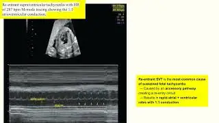Fetal Arrhythmias Made Easy | M-Mode Techniques Every Sonographer Should Know (4-Min Quick Review)