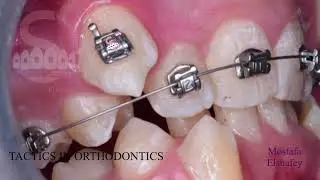 Orthodontic treatment of deep bite and high canine