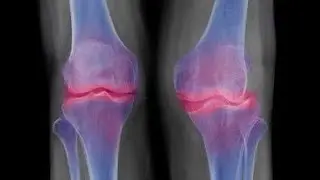 Sclerosis or cysts on X ray; distinct changes in bone density and structure