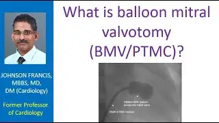 What is balloon mitral valvotomy (BMV/PTMC)?