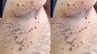 Only 2 Ingredients remove skin tag in 3 days, skin tag removal challenge