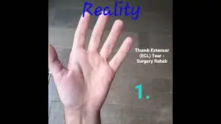 Extensor Tendon Tear - Surgery Rehab - Thumb #tendon #tear #surgery #rehab #recovery