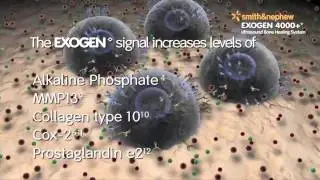 Exogen Bone Stim