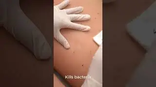 Black acid peel for back at Body Lab in Bali