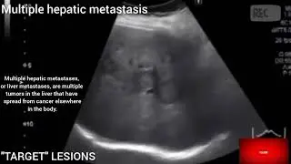 Multiple hepatic metastasis I Liver mass lesions I Target lesions I Liver cancer I Hepatic malignanc