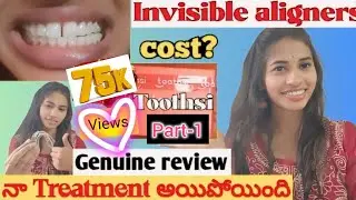 My Toothsi invisible aligners journey in telugu|Final review & Complete information #toothsialigners