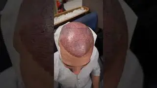 SECONDO TRAPIANTO?