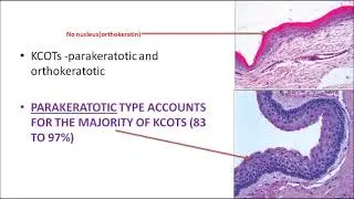 ORALPATH- CHAP 3- PART 1 - ODONTOGENIC  CYSTS  - ENGLISH