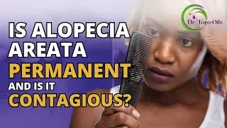 Is Alopecia Areata Permanent And Is It Contagious?