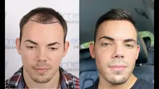 Hair Transplantion in Turkey - Experience With Health Travels | 1 year (before / after)