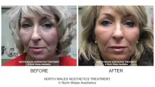 Nia Full Side Face Dermal Filler Treatment Before & After Videos