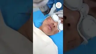 How Laser Toning Treatment Can Transform Your Acne Spots? - Charma Clinic