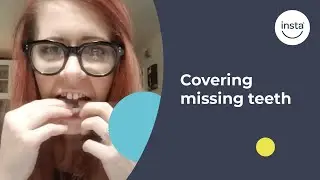 Covering Cracked and Missing Teeth | Instasmile Review