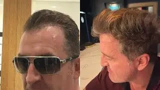 Amazing Hair Regrowth! 10,000 New Hairs in 3 Months with NewHairFormula!