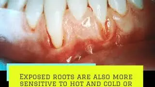 Smokeless tobacco can irritate your gum tissue, causing it to recede or pull away from your teeth.