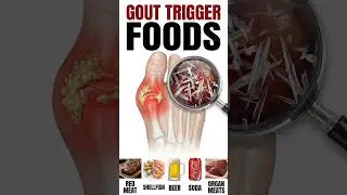 WORST Gout Trigger Foods | What Causes Painful Gout Flare-Ups