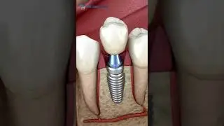 Dental Implant I Dental Holiday Turkey