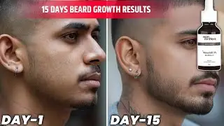 सिर्फ 15 दिन minoxidil लगाके beard growth होगा ? man matters beard oil review|minoxidil beard growth
