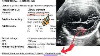 Pregnancy Scan Report At 35 Weeks 5 Days | Baby Boy | Fetal Ventriculomegaly