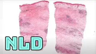 NLD Necrobiosis Lipoidica Diabeticorum (firm yellow-red-brown skin on shins in diabetes) dermpath