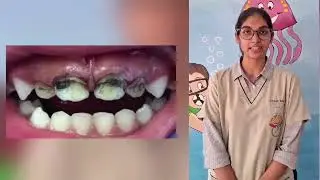 Pt Educational Video on Silver Diamine Fluoride (SDF)