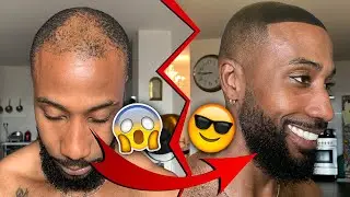 COMMENT CACHER SA CALVITIE ( toppik )