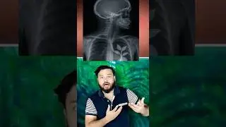 Plant INSIDE Lungs! Very RARE Medical CASE&nbsp;#shorts