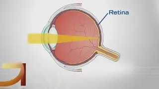 Good Question: How Do Glasses & Contacts Work?