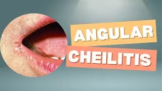 Angular Cheilitis Explained | Causes, Symptoms & Treatment (From A to Z Derma)