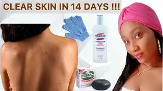 HOW TO GET RID OF BACK ACNE/BODY ACNE : Acne Removal + How to get rid of back acne #soap #acne