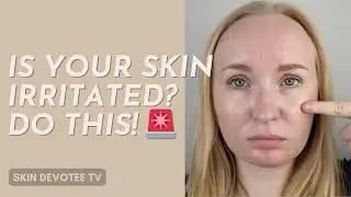 How To Soothe Irritated Skin FAST! 🧘&zwj;♀️💆&zwj;♀️
