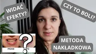 WYBIELANIE ZĘBÓW METODĄ NAKŁADKOWĄ - CO POSZŁO NIE TAK?