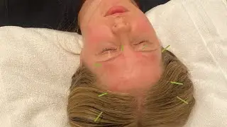 Acupuncture for chronic headache