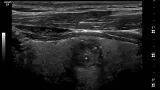 Punctate echogenic foci in the thyroid