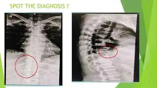 Diffuse Idiopathic Skeletal Hyperostosis vs Axial Spondylarthritis(How to differentiate?)