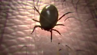 Lyme disease