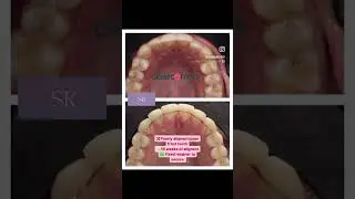Fixed retainer after ClearCorrect aligners #dentist #clearcorrect #drsanaakader #indigodental #leeds