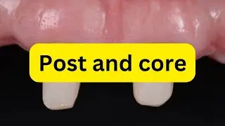 Post and core indications and steps SIMPLIFIED