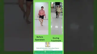 Benefits of polio treatment #polio