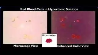 hemolysis crenation