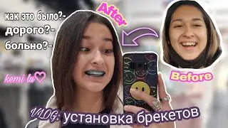 VLOG: установка брекет системы// установка брекетов// kemi lu
