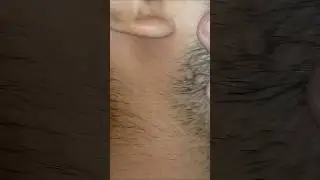 #salon #hairproblem #asmr#ingrownhairremoval #removehair #satisfying #oddlysatisfy
