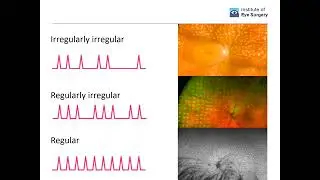 Webinar: Retinal tracking - One big leap towards true-confluent, repeatable image guided laser