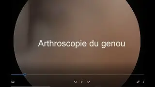 r&eacute;section de languette meniscal sous arthroscopie
