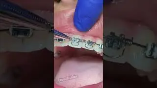 Ортодонтия Torque Springs - Брекеты на ногах - Семейная стоматология Tooth Time в Нью-Браунфелсе