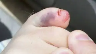 I Broke My Toe!