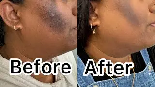 Melanostop tranex peel with depigmentation solution microneedling. #mesoestetic #chemicalpeel
