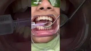 Root Canal Treatment in Kolkata | RCT Procedure Step by Step- #rootcanaltreatment #dental #dentistry